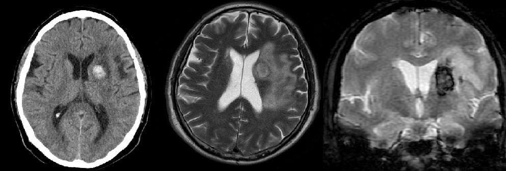 Haemorrhagic stroke is a life-threatening cerebrovascular emergency caused by the rupture of a blood vessel, resulting in bleeding into the brain parenchyma or the subarachnoid space. It accounts for approximately 10–20% of strokes in many high-income populations but contributes disproportionately to mortality and long-term disability. The two principal types, intracerebral haemorrhage and subarachnoid haemorrhage, differ in their underlying causes, clinical presentation and management. Hypertension, cerebral amyloid angiopathy, intracranial aneurysms and coagulation disorders are among the major aetiological factors. Early recognition, rapid neuroimaging and targeted treatment are essential to limit secondary brain injury, prevent complications and improve clinical outcomes. This review examines the pathophysiology, epidemiology, clinical presentation, diagnostic approach, treatment strategies and prognosis of haemorrhagic stroke.